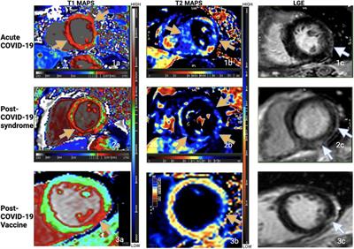 Phenotyping myocardial injury related to COVID and SARS-CoV-2 vaccination: insights from cardiovascular magnetic resonance